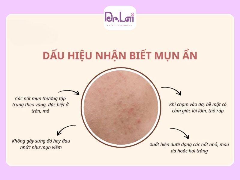 Mụn ẩn nằm sâu bên trong da