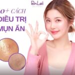 Cách trị mụn trứng cá ở lưng