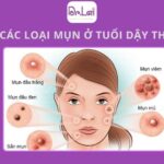 Mụn trứng cá tuổi dậy thì