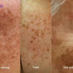 Trị nám tàn nhang đồi mồi