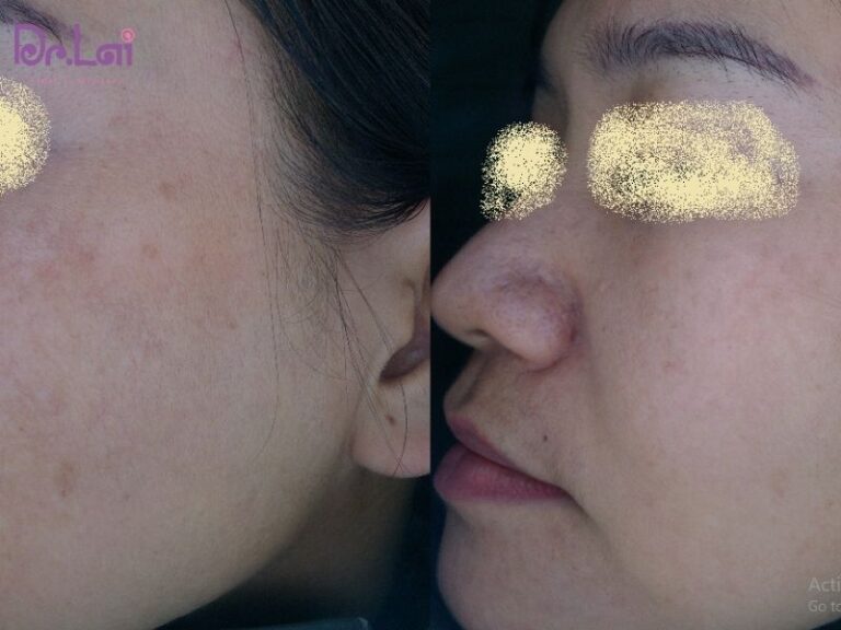 Những ai phù hợp với laser YAG?