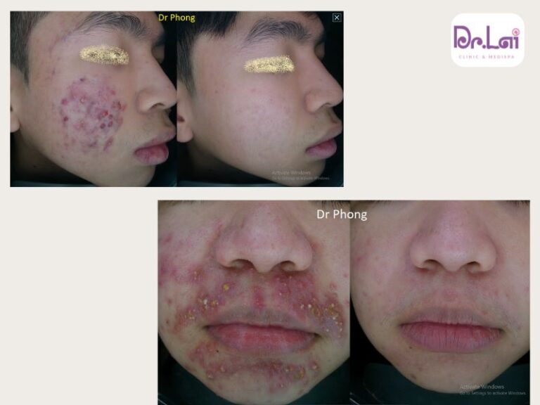Hình ảnh thực tế trị mụn trứng cá tại Dr.Lai