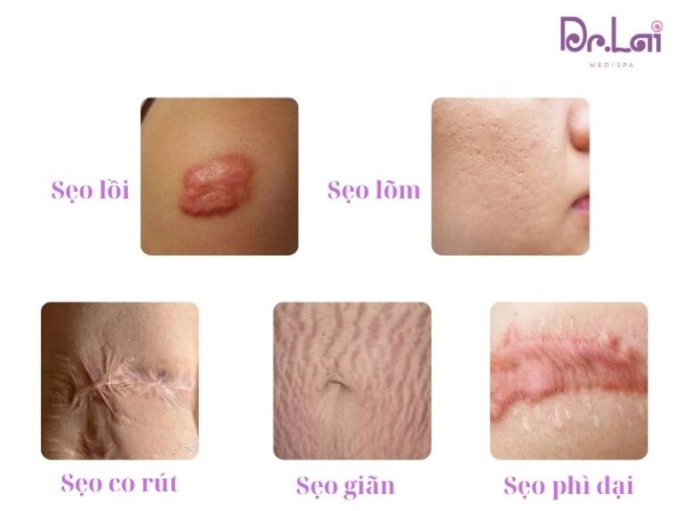 Cắt đáy sẹo phù hợp với những loại sẹo nào?
