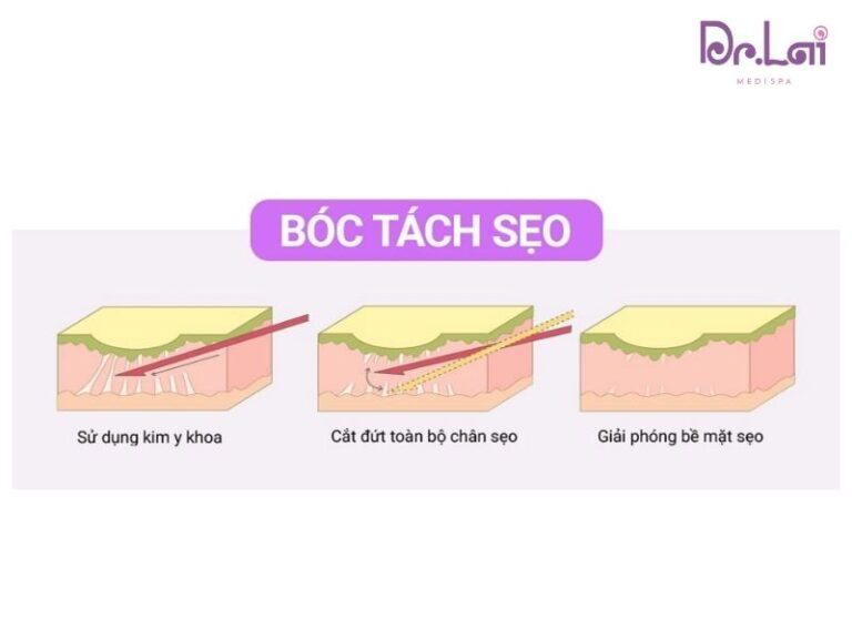 Cắt đáy sẹo rỗ
