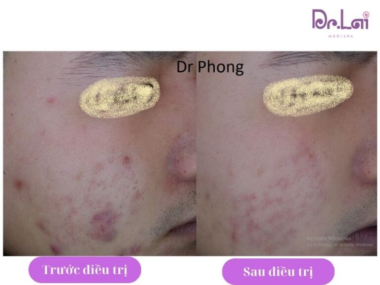 Cắt đáy sẹo bao nhiêu lần thì có kết quả?