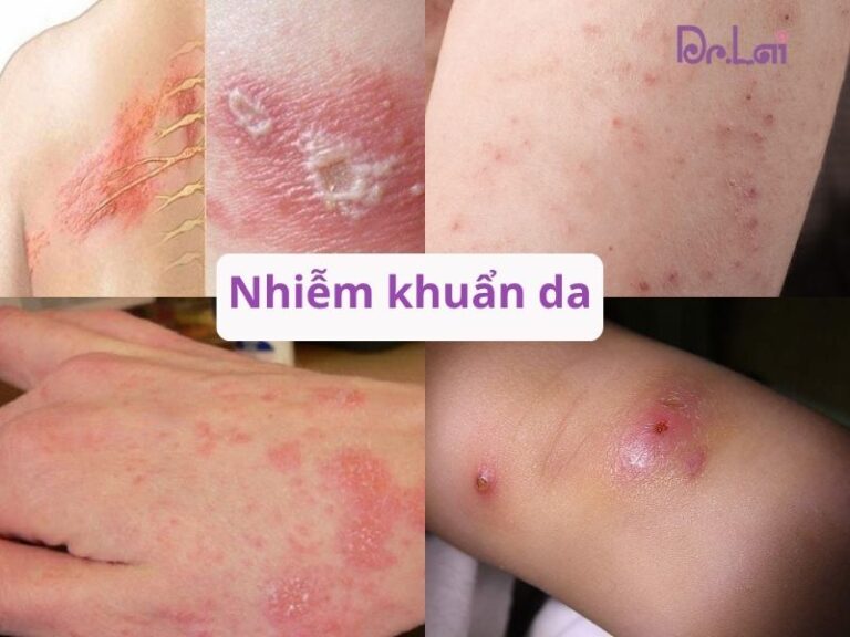Các loại bệnh nhiễm trùng da do vi khuẩn