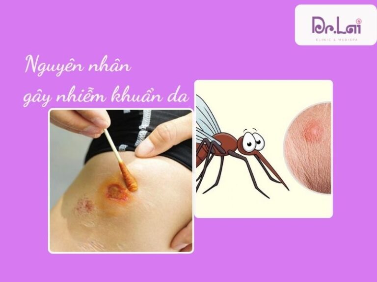 Nhiễm khuẩn da