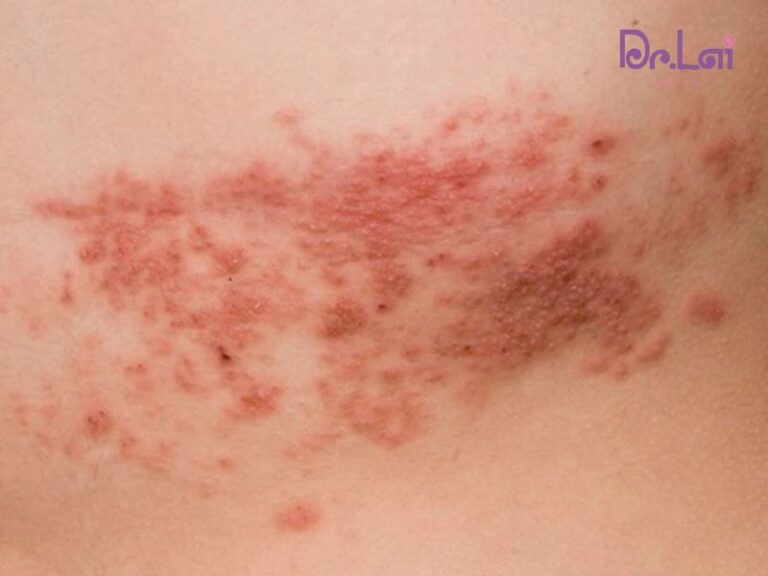 Vì sao virus làm tổn thương da?