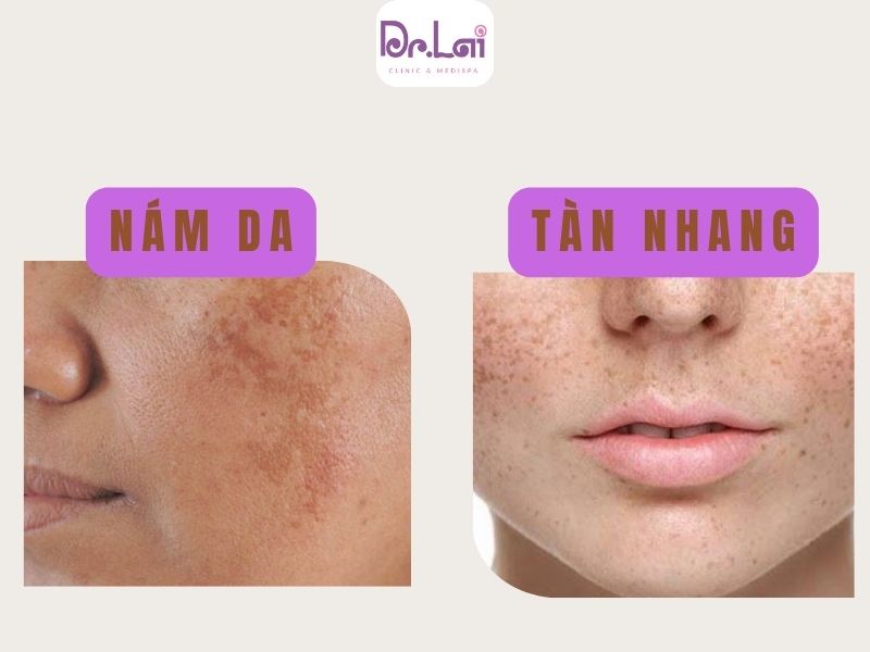 Nám, tàn nhang và đồi mồi