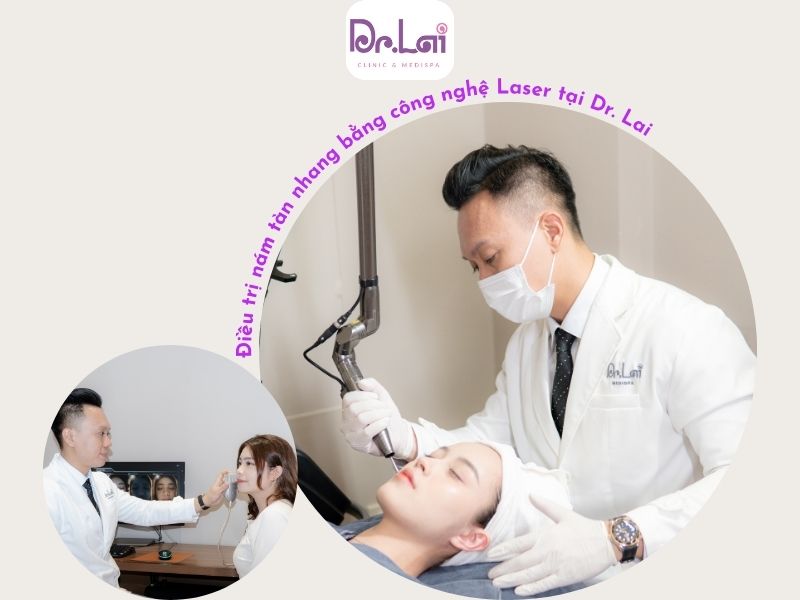 trị thâm mụn bằng laser YAG