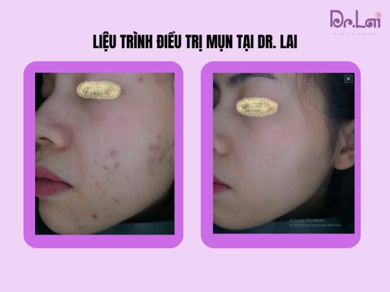 Khi nào nên điều trị thâm mụn tại spa?