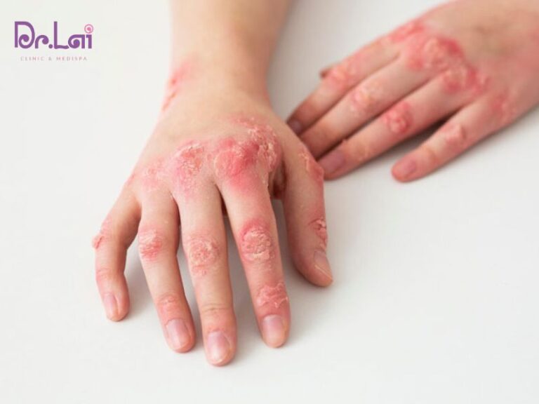 Điều trị bệnh chốc