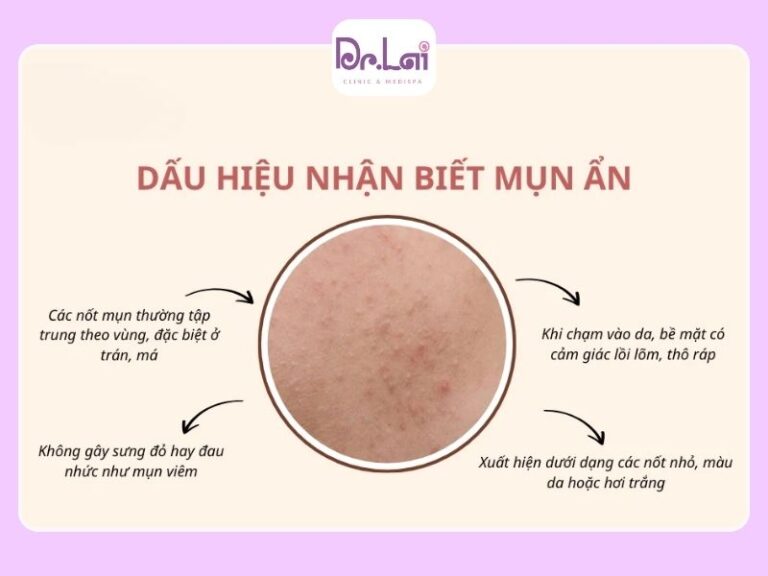 Mụn Ẩn Lại Hình Thành Dưới Da