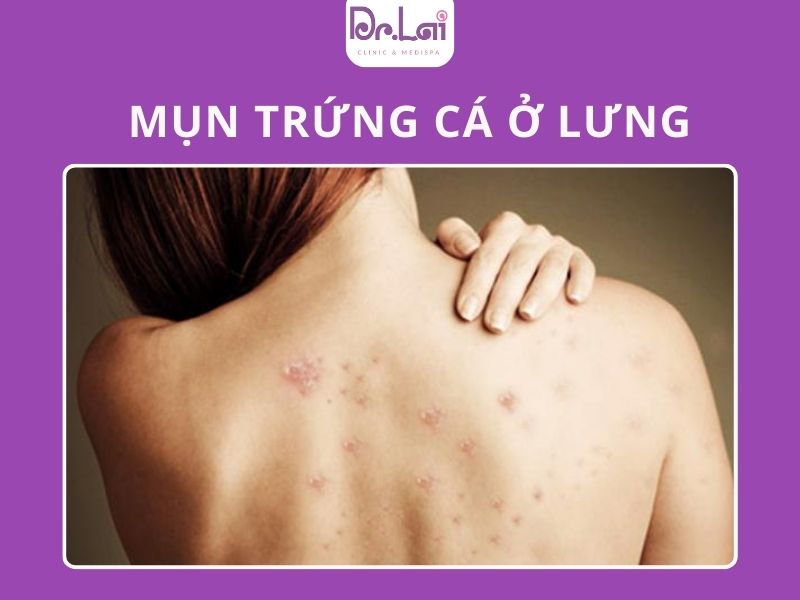 mụn trứng cá lại phát triển mạnh ở lưng