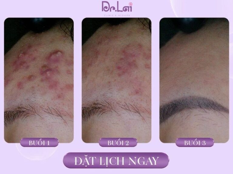 Tác hại của việc xử lý mụn sai phương pháp