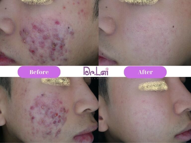Quy Trình Trị Mụn Chuẩn Y Khoa Tại Da Liễu Dr. Lai