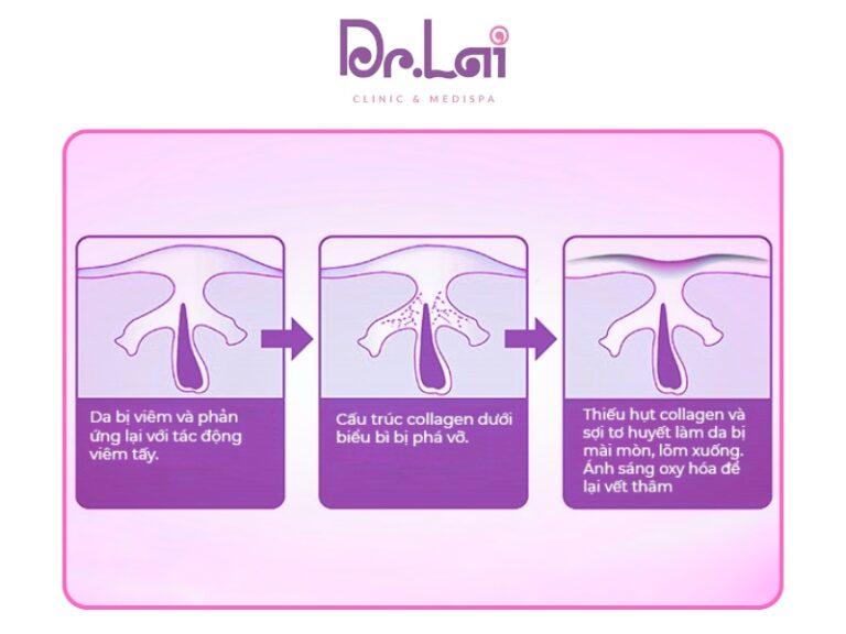 Sai lầm phổ biến khiến vết thâm mụn bám sâu hơn