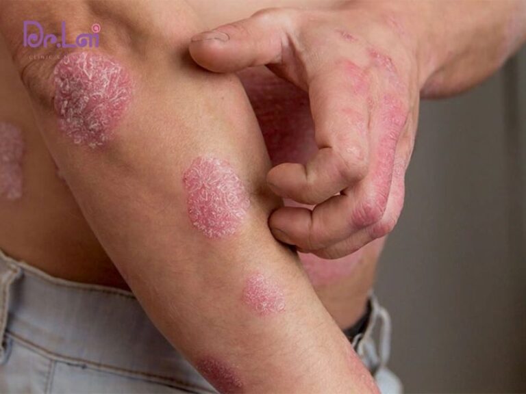 Nguyên nhân và yếu tố khiến vảy nến bùng phát
