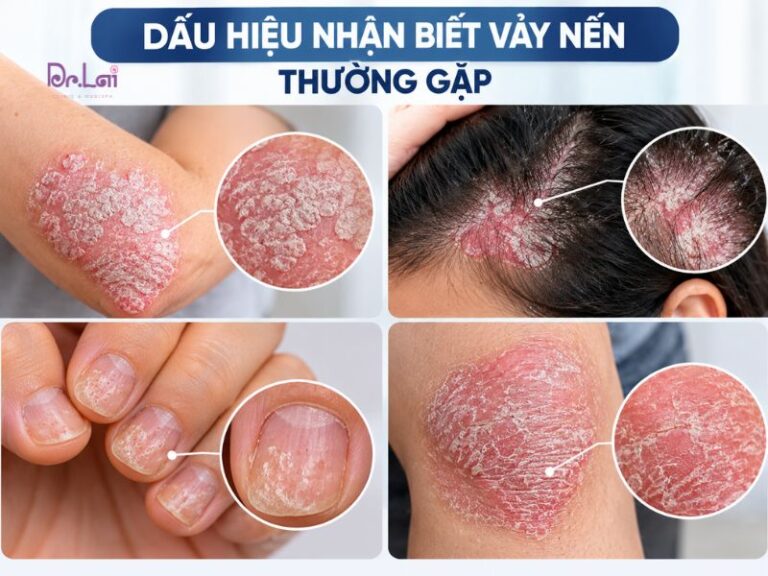 Dấu hiệu nhận biết bệnh vảy nến
