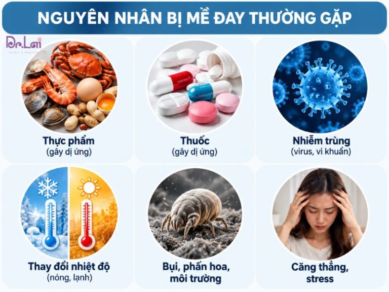Những tác nhân có thể khiến mề đay bùng phát