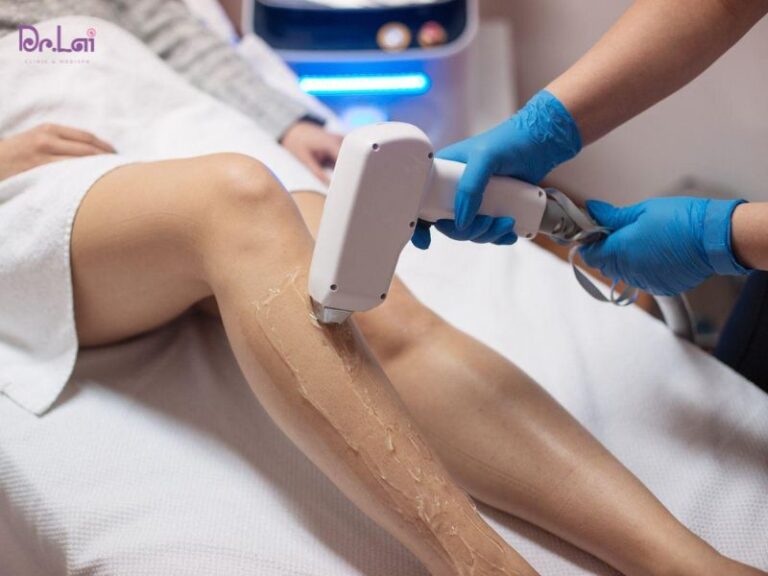 Triệt lông bằng Laser